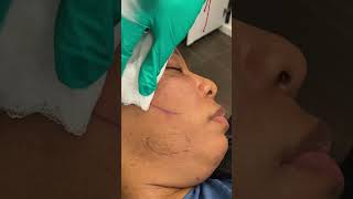 Acne Scar Subcision [upl. by Forlini]