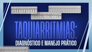 Taquiarritmias Diagnóstico e Manejo Prático [upl. by Gerrit]