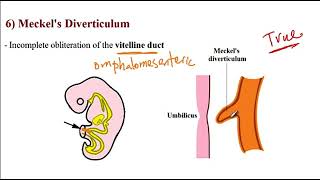 USMLE ACE Video 157 Common Gastrointestinal Disorders [upl. by Savvas]