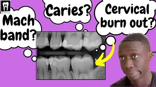 Caries Vs Cervical burnout Vs Mach band effect  Interpretation of Dental Caries [upl. by Mariette]