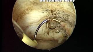 Hysteroscopic Myoma Resection For Deep Submucous and Intramural Myomas [upl. by Ramon]