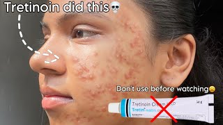 Tretinoin mistakes that ruined my skin 😫 tretinoin skincare beauty [upl. by Elokcin]