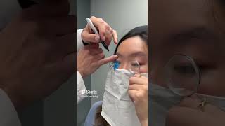 Fitting A Scleral Lens With Eyeprint Pro keratoconus eyedoctor dryeyes contactlenses [upl. by Llorrad]