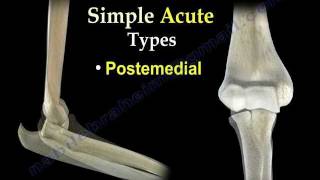 Elbow Dislocations  Everything You Need To Know  Dr Nabil Ebraheim [upl. by Granthem]