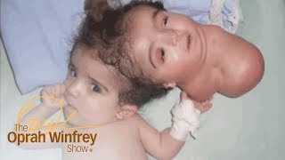 The 2Headed Baby Miracle  The Oprah Winfrey Show  Oprah Winfrey Network [upl. by Ronalda327]