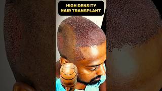 HAIR TRANSPLANT में क्या  क्या होता है shorts shortvideo hairtransplant hairloss [upl. by Idur821]