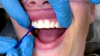 Tips For Applying Fluoride Varnish [upl. by Urdna]