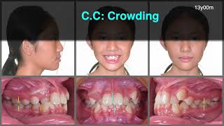 Treatment of Supernumerary Teeth and Crowding｜【Chris Chang Ortho】CC776 [upl. by Rolyt]