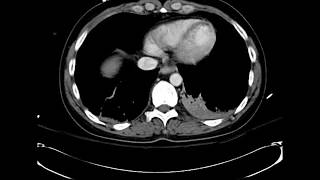 What is your diagnosis Myocardial infarct on Chest CT [upl. by Adnawal]