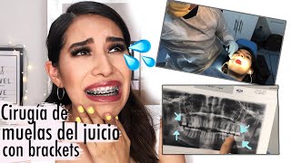 Mi experiencia con brackets 6  CIRUGÍA DE MUELAS DEL JUICIO Cirugía de Cordales Carel Quezada [upl. by Enutrof]