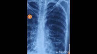 3 signs of bronchiectasis on chest xray and treatment  asthma and its complicationschestxraymbbs [upl. by Casi879]