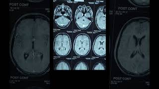 Pork alcohol nd Disease Neurology [upl. by Anuaek]