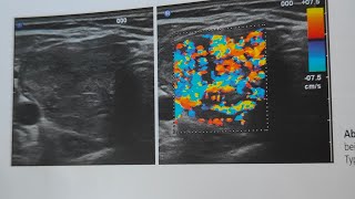 Facharztprüfung Innere Medizin Morbus Basedow [upl. by Theron]