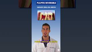 Estas son las CAUSAS de la PULPITIS reversible o INFLAMACIÓN del NERVIO DENTAL [upl. by Eneloc]