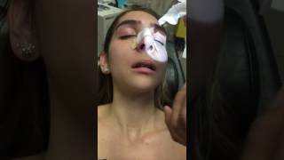 Removing a Nasal Stent 5 Days after Rhinoplasty [upl. by Marela]