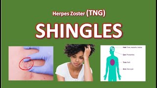 Shingles Management Risk Factor Infections and Treatments [upl. by Ahsinek127]