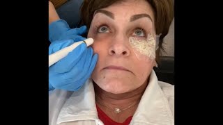 Would you Burn your Face for Beauty  I DID  Plasma Fibroblast [upl. by Fadiman]