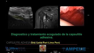 Como diagnosticar capsulitis adhesiva en ultrasonido y como realizar tratamiento ecoguiado [upl. by Pember]