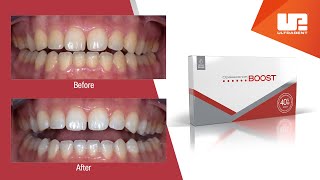 Opalescence Teeth Whitening Instructional Video [upl. by Kirred]