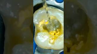 guttapercha Removal using Retreatment D1 D2  D3 Rotary files الكربولة [upl. by Nahshun]