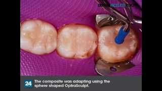 How to Cut Procedure Time in Half with Tetric EvoCeram Bulk Fill [upl. by Ominoreg342]