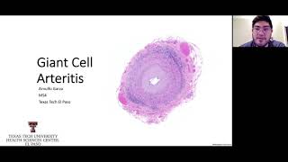 Giant Cell ArteritisTemporal Arteritis [upl. by Eustacia]