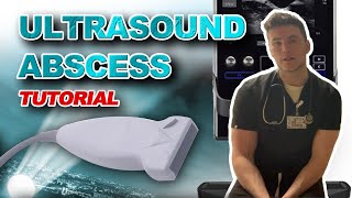 Ultrasound Guided Abscess Drainage [upl. by Bhatt]