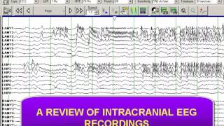 INTRACRANIAL DEPTH ELECTRODE RECORDING [upl. by Esirtal97]