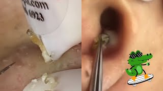 Ultimate ASMR Pimple Popping Compilation  Blackhead amp Cyst Extraction for Maximum Relaxation [upl. by Asyen]