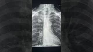 Find the abnormality radiology chestxray xray [upl. by Erual]