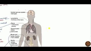 Extrapulmonary TB [upl. by Neall]