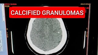 Calcified Granulomas in Brain [upl. by Lihka562]