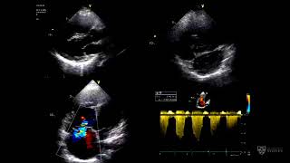 Pulmonary hypertension in adult congenital heart disease – Dr David Tanous [upl. by Amitaf]