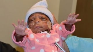 One of Worlds Smallest Premature Babies Leaves Hospital After Beating Odds [upl. by Hilar28]