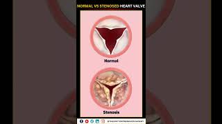 Normal vs Narrowed Stenosed Heart Valve education neet biology heart [upl. by Florry]