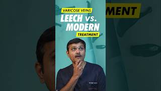 Can Leech Therapy REALLY Cure Varicose Veins [upl. by Higgs]