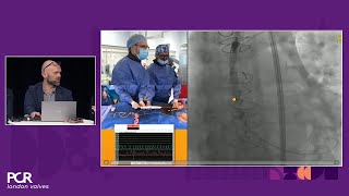 Pushing the boundaries to optimise patient outcomes in TAVI from planning to success  PCRLV [upl. by Onaicnop]