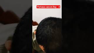 Finstried Day 41 threvico stop hair loss finasteride stophairfall ytshorts [upl. by Karas]