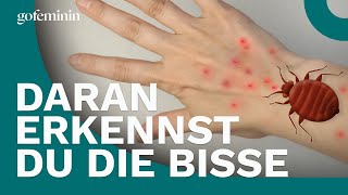 Bettwanzen Daran erkennst du die Bisse [upl. by Anirtap]