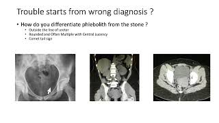 Phlebolith vs Lower Ureteric Stone  How to Diffrentiate [upl. by Ahsir409]