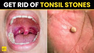 How to Prevent Tonsil Stones  Try 10 Ways  Credihealth tonsilitis tonsils [upl. by Archer420]