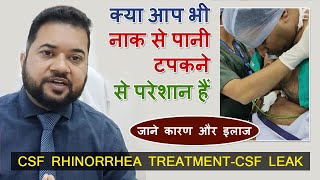 CSF RHINORRHEA TREATMENTCSF LEAK  Hindi  Dr Vikram Bhardwaj [upl. by Davenport]