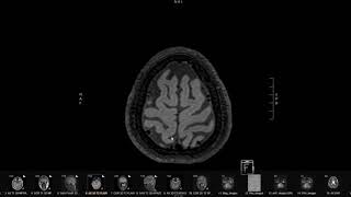 MRI of Severe Headache [upl. by Gomar273]