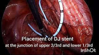 LAPAROSCOPIC URETEROLITHOTOMY FOR LOWER URETERIC STONE [upl. by Gibbons]