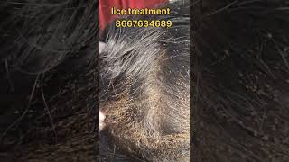 How to remove nits and lice treatment nits hair headlice haircare lice nits and lice removal [upl. by Esidnac]