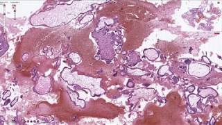 Products of Conception  Histopathology [upl. by Nyrhtak]