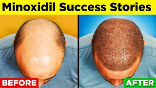 MINOXIDIL  A StepbyStep Guide to Regain Your Hair [upl. by Kramal]