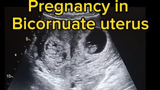 pregnancy in bicornuate uterus ultrasound case [upl. by Riocard]