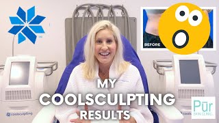 My COOLSCULPTING Results  CoolSculpting Before amp After  Does It Work  Pūr Skin Clinic [upl. by Attenhoj]