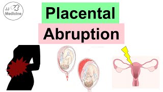 Placental Abruption Abruptio Placentae Risk Factors Symptoms Complications Diagnosis Treatment [upl. by Haile]